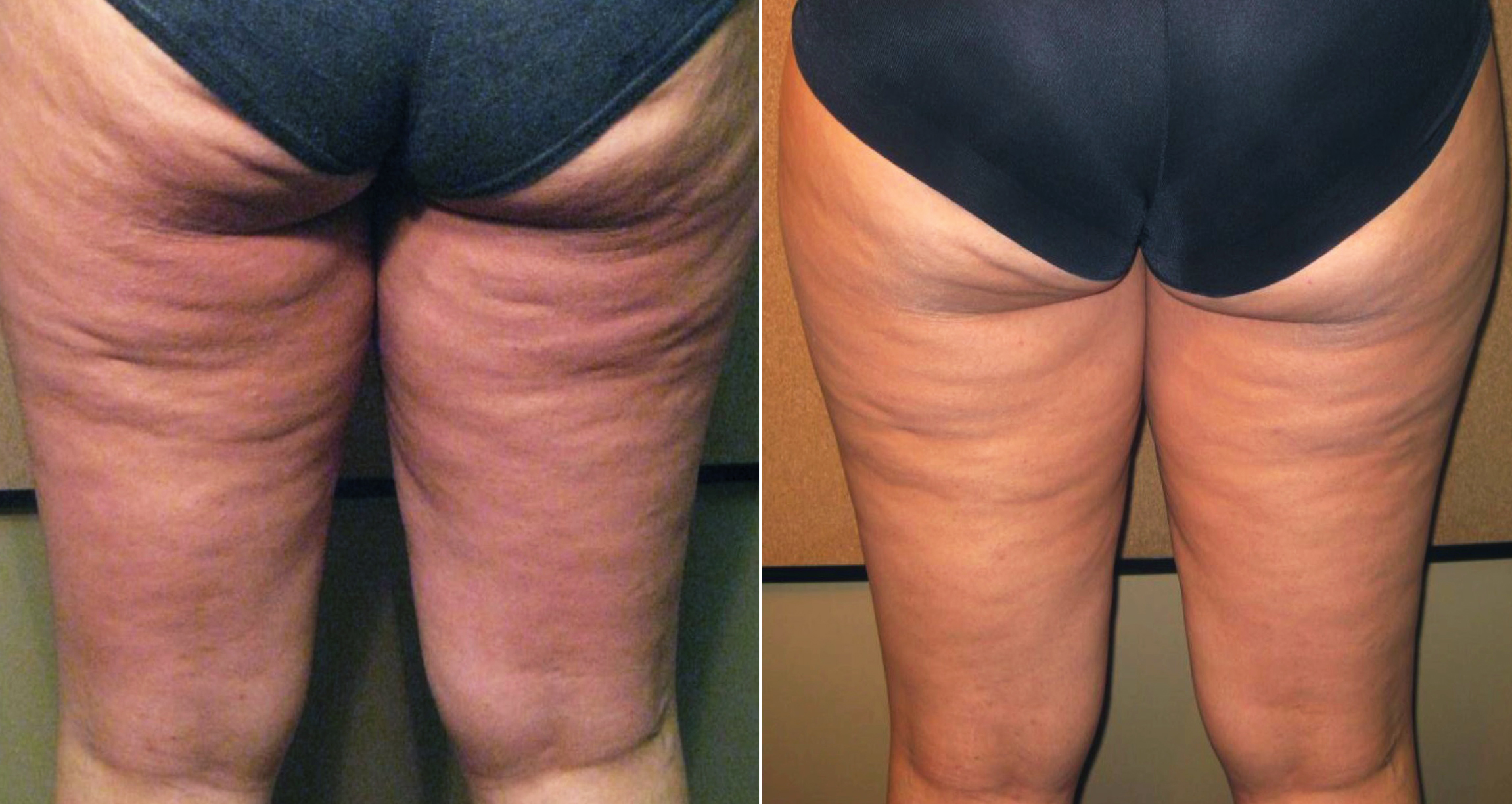 Trattamento di radiofrequenza Thuzzle per la riduzione della cellulite e tonificazione delle gambe