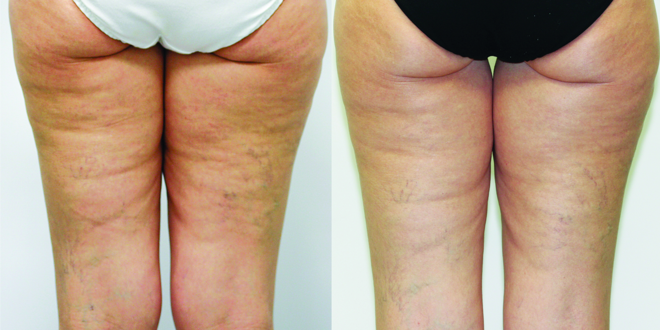 Trattamento di radiofrequenza Thuzzle per la riduzione della cellulite e tonificazione delle gambe