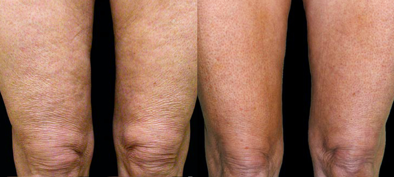 Trattamento di radiofrequenza Thuzzle per la riduzione della cellulite e tonificazione delle gambe